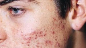 atomy acne